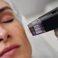 Woman receiving microneedling treatment in a skincare clinic